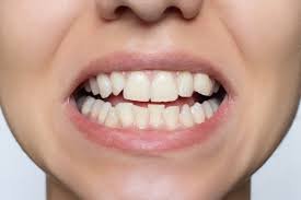 How to Fix Crooked Teeth Without Braces in Houston
